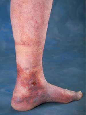 veinous leg ulcer